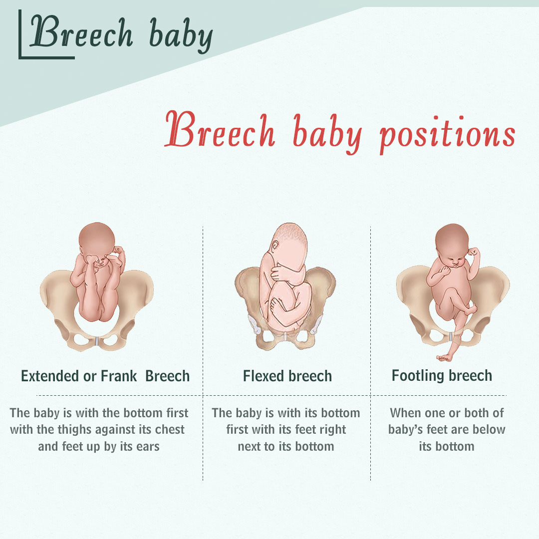 breech presentation vs cephalic presentation