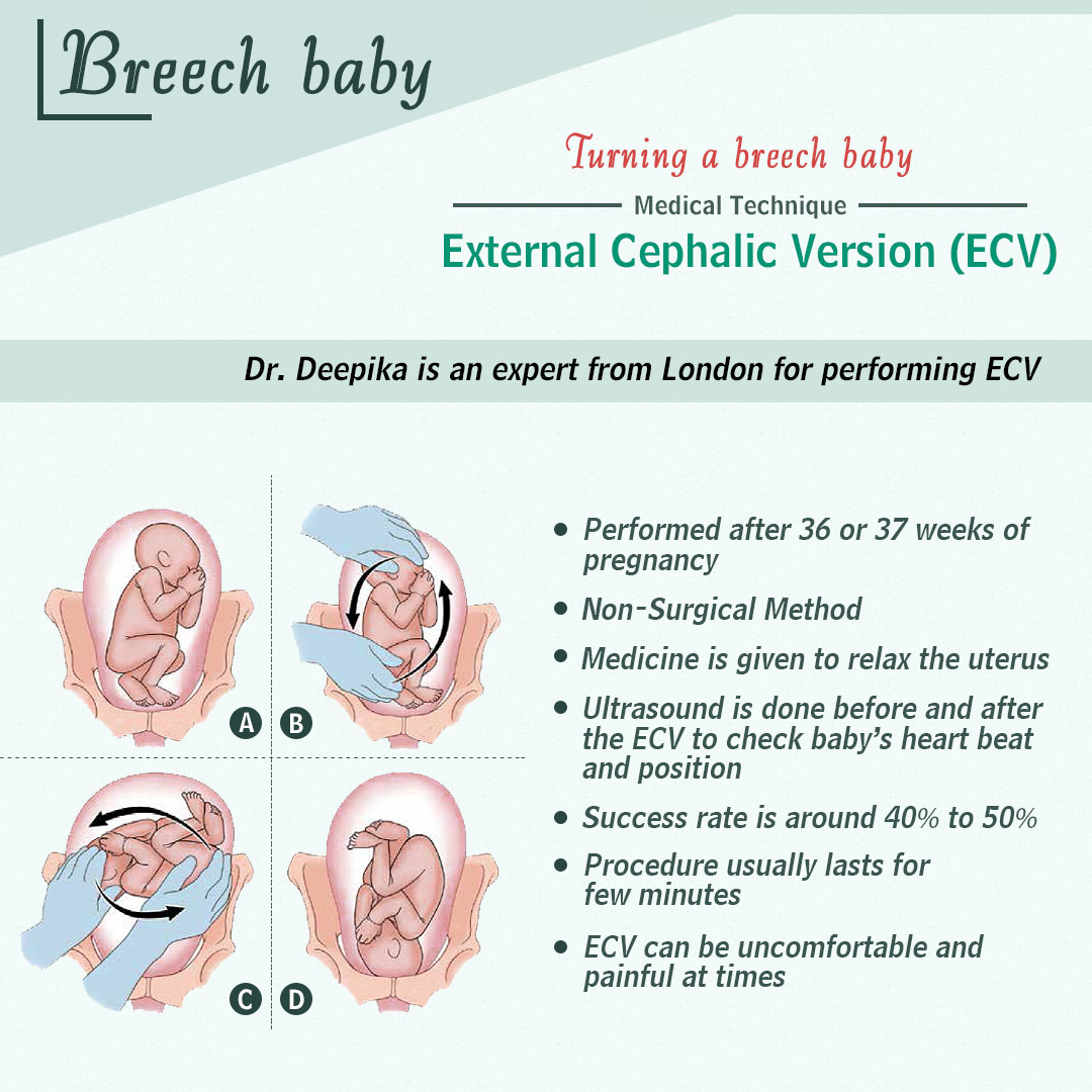 what is external cephalic version in breech presentation